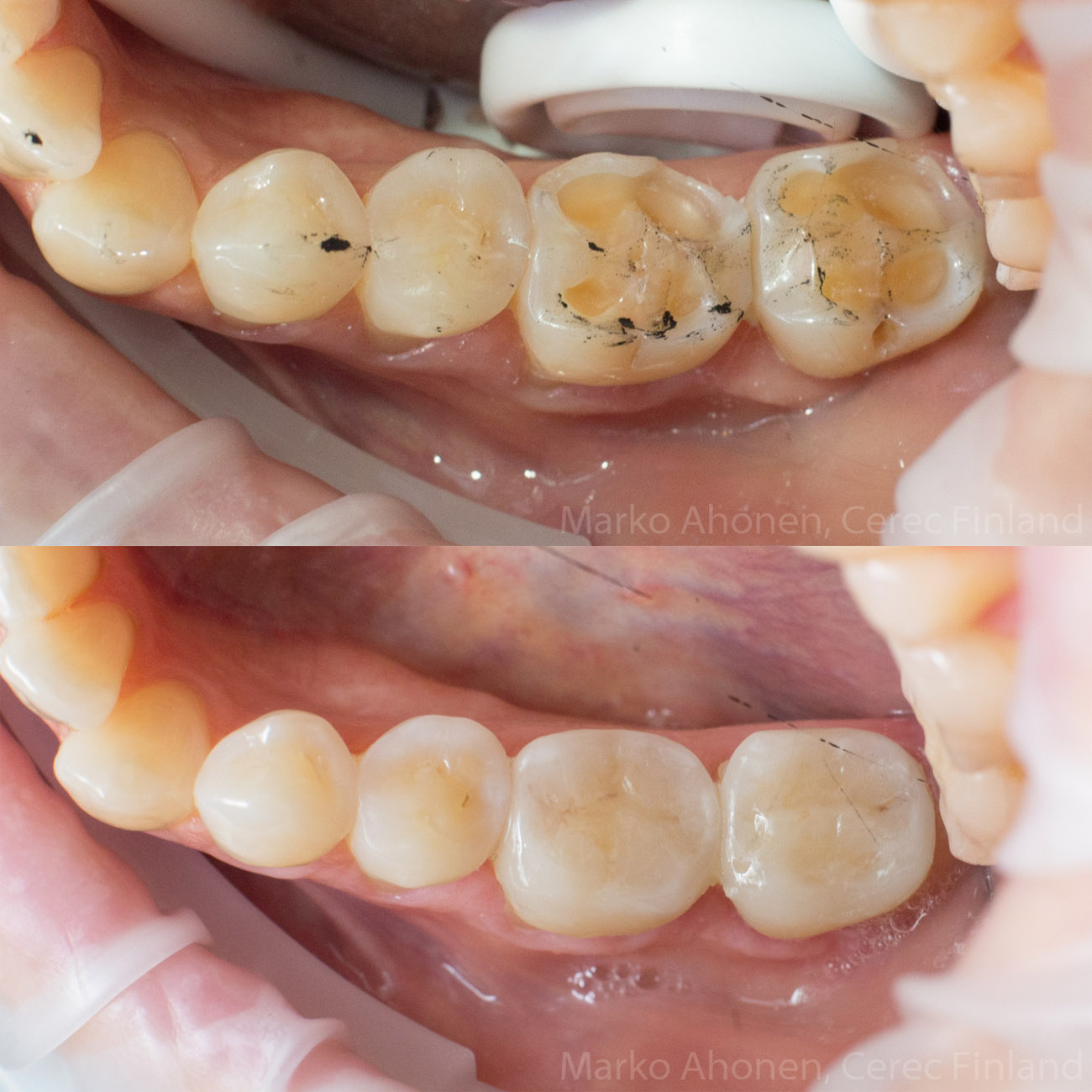 hampaiden eroosio