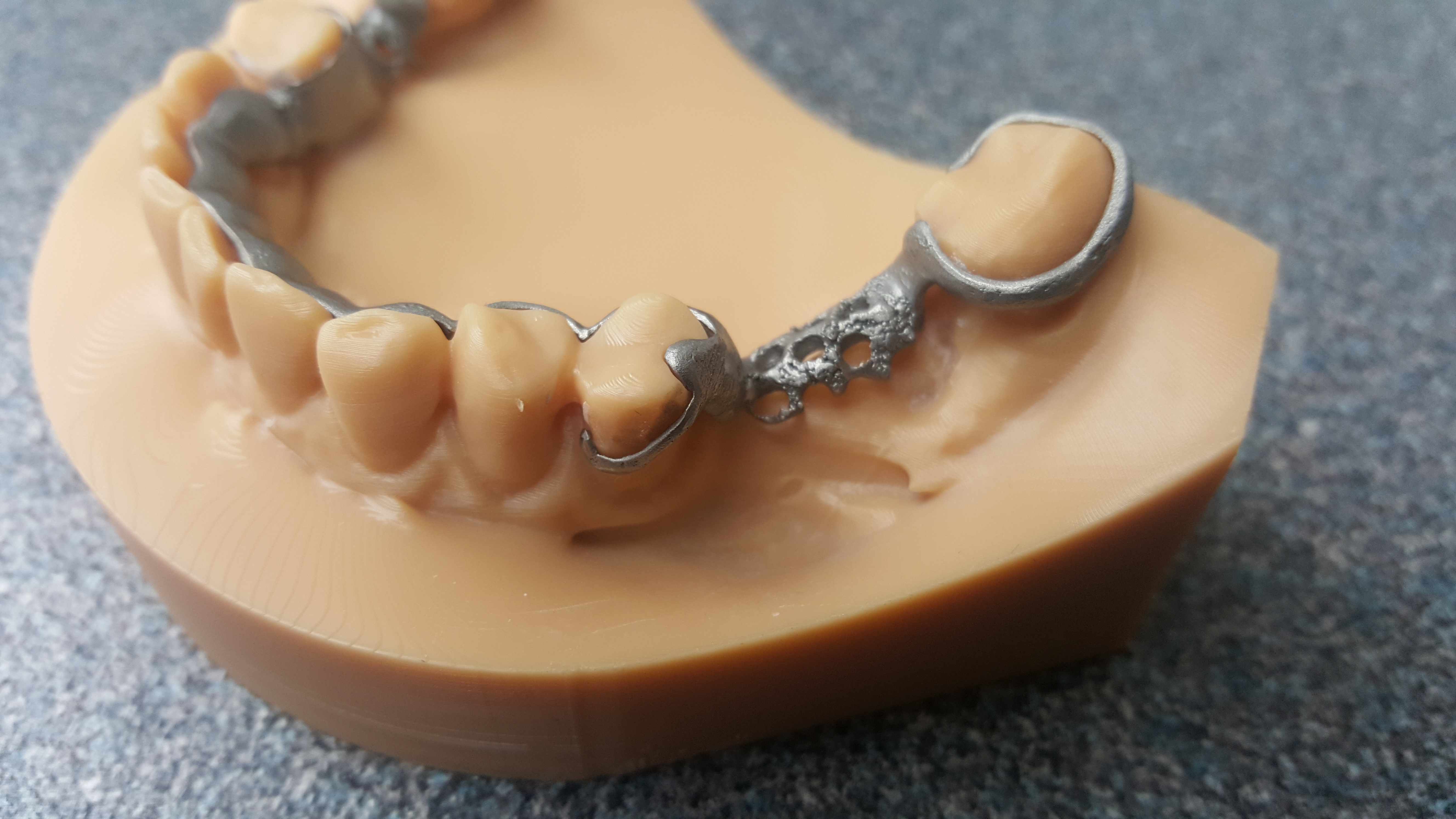 Metallirankainen Osaproteesi T ysin Digitaalisesti Cerec Finland